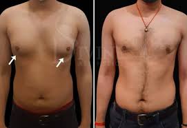 gynecomastia before after results