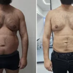liposuction before and after