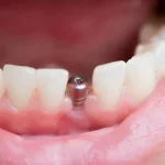 dental implants Perth, dental implants, dental implants in Perth