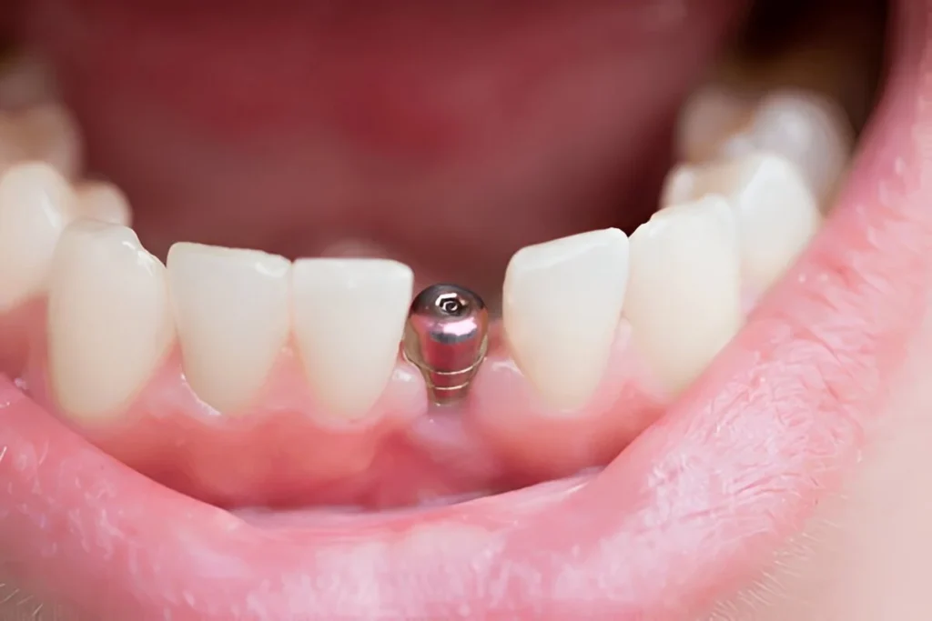 dental implants Perth, dental implants, dental implants in Perth