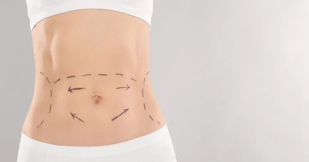Cost-of-Tummy-Tuck-in-Dubai