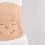Cost-of-Tummy-Tuck-in-Dubai