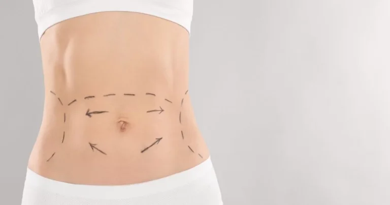 Cost-of-Tummy-Tuck-in-Dubai
