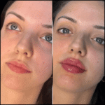 Fillers in Dubai