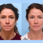 Best Doctors in Dubai Offering Thread Lift for Enhanced Facial Definition