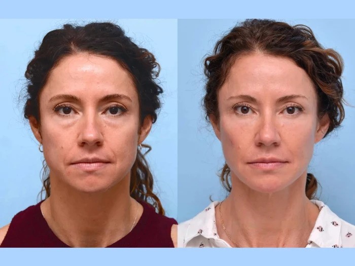 Best Doctors in Dubai Offering Thread Lift for Enhanced Facial Definition