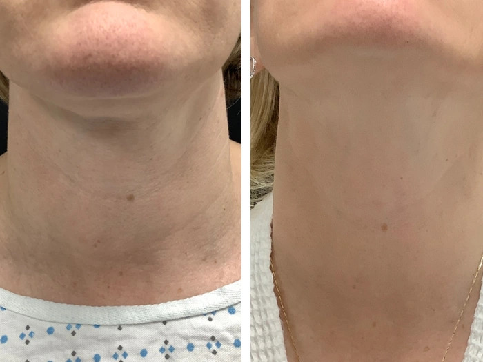 Best Aesthetic Clinic in dubai for Radiofrequency Microneedling Cheek Rejuvenation