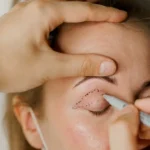 Eyelid Surgery in Riyadh to Reduce Under Eye Bags and Excess Skin Naturally