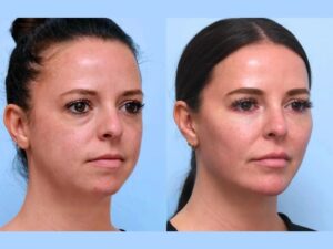 Best Plastic Surgeons in Dubai: Facial Contours Using Advanced Thread Lift