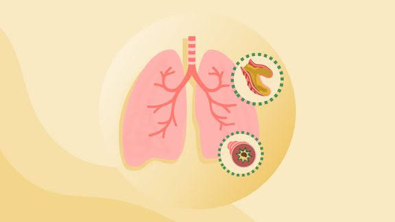 How One Patient Reversed Bronchiectasis Symptoms Without Surgery