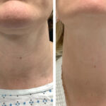 Best Doctors in dubai for RF Microneedling Fine Texture Refinement