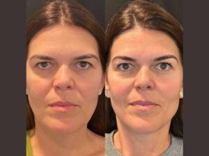 Best Aesthetic Clinics in Dubai for Customized Thread Lift Treatments