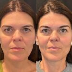 Best Plastic Surgeons in Dubai: Innovative Cosmetic Enhancement Through Thread Lift