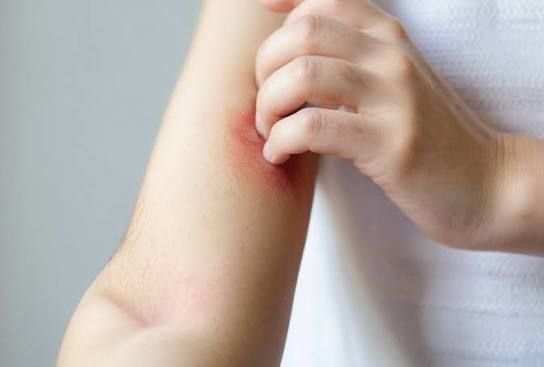 These Natural Remedies for Bullous Pemphigoid